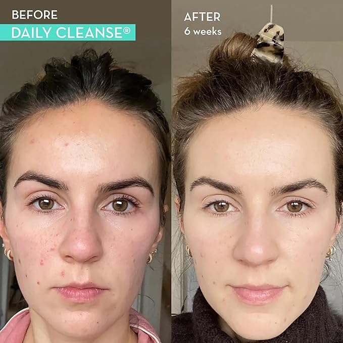 HUM Daily Cleanse Acne Supplement - Gut Cleanse Detox for Clear Skin with Organic Algae, Detoxifying Herbs, Zinc & Spirulina | Clear Skin Supplement (60 Capsules)-SeraviaPure
